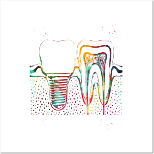 Human teeth and dental implant Posters and Art